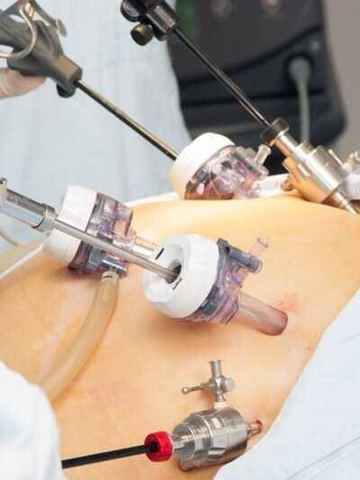 Somente a laparoscopia ou a cirurgia robótica são indicadas pra retirar os focos de endometriose. A cirurgia convencional pode falhar em enxergar os focos e tem menor precisão.