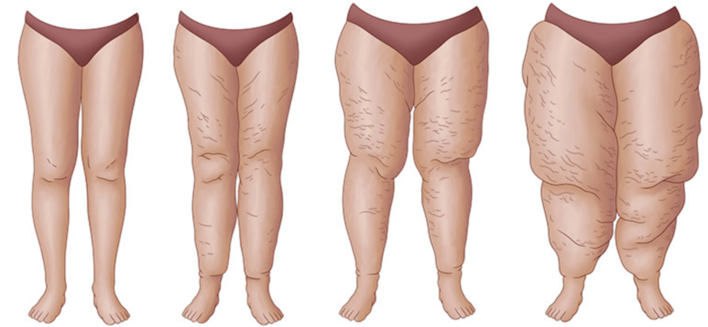 Os diferentes estágios do lipedema