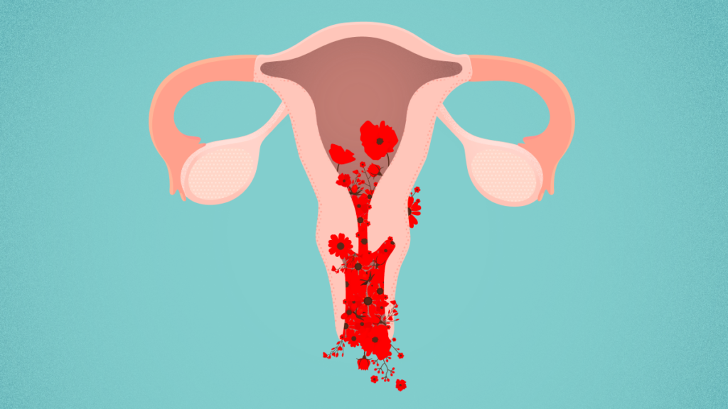 O sangramento uterino anormal impacta muito na qualidade de vida da mulher.