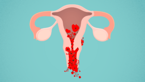 O sangramento uterino anormal impacta muito na qualidade de vida da mulher.